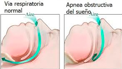 IFN - Apnea obstructiva del sueño, otro enfoque ampliado ¿Pueden los ronquidos alertar de otras enfermedades