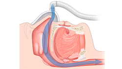 IFN - El retiro del Cpap