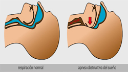 IFN - Qué es una apnea obstructiva